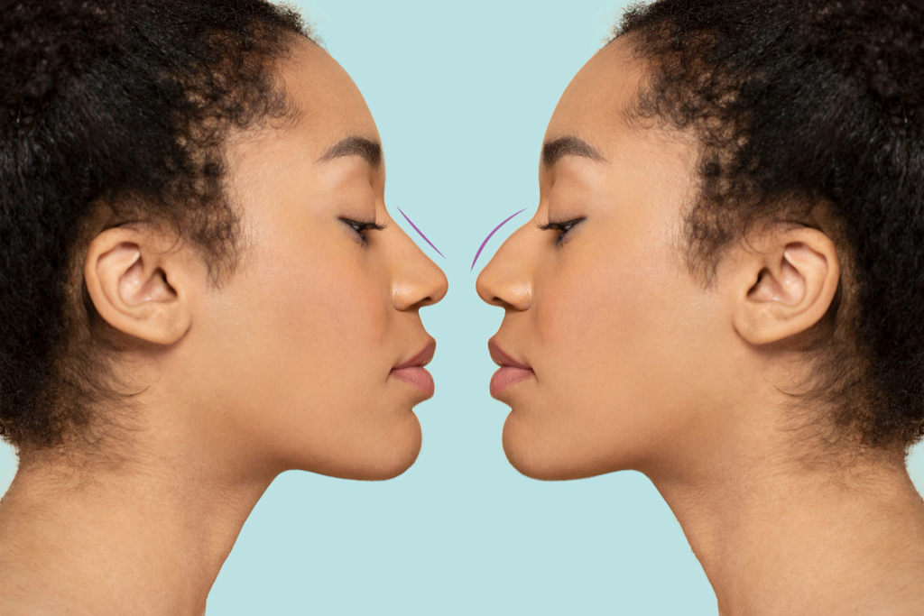 Rinoplastia redutora