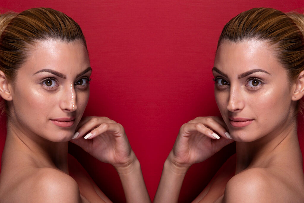 Mulher demonstrando o antes e depois da rinoplastia para nariz pequeno