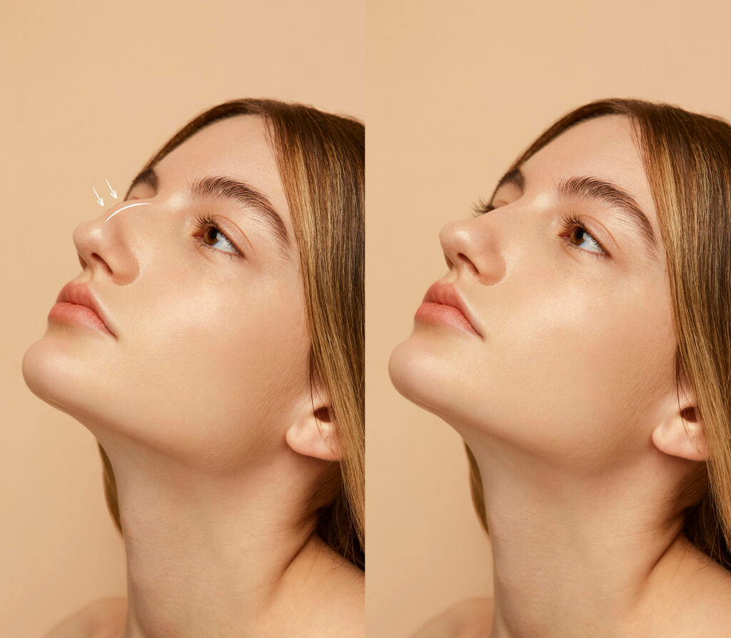 Antes e depois da rinoplastia, nariz de uma mulher antes e depois do procedimento