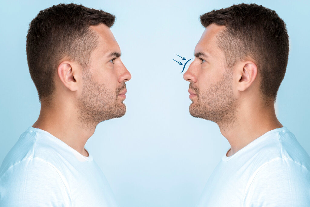 Antes e depois da rinoplastia, nariz de homem antes e depois do procedimento