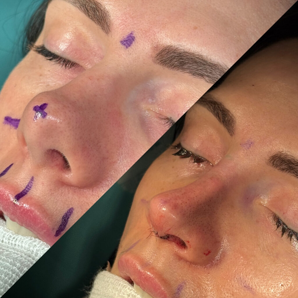 Antes e depois de paciente com rinoplastia natural em Salvador meio perfil