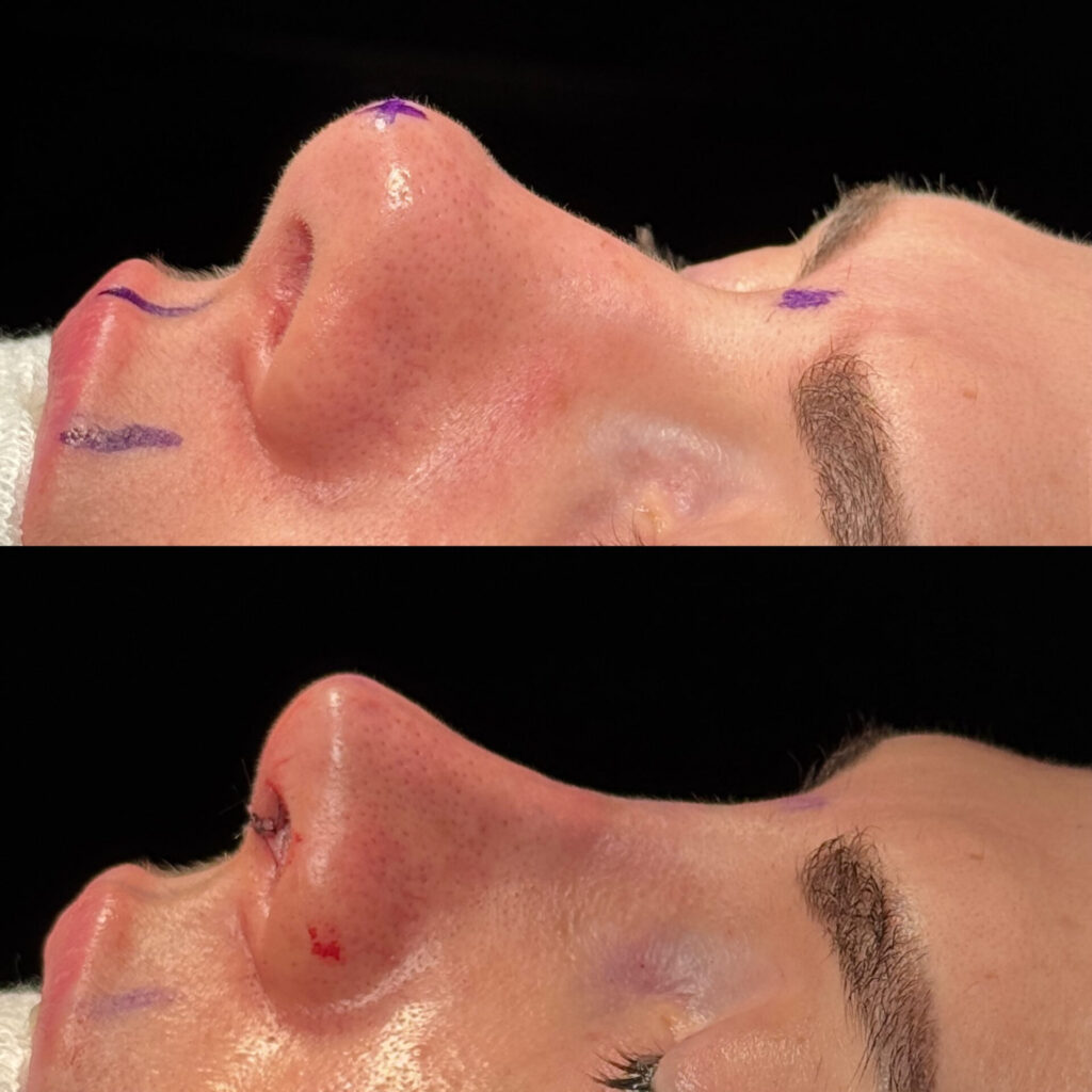 Antes e depois de paciente com rinoplastia natural em Salvador perfil esquerdo