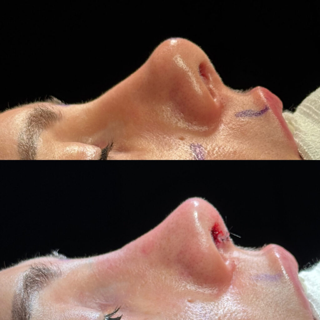 Antes e depois de paciente com rinoplastia natural em Salvador perfil direito