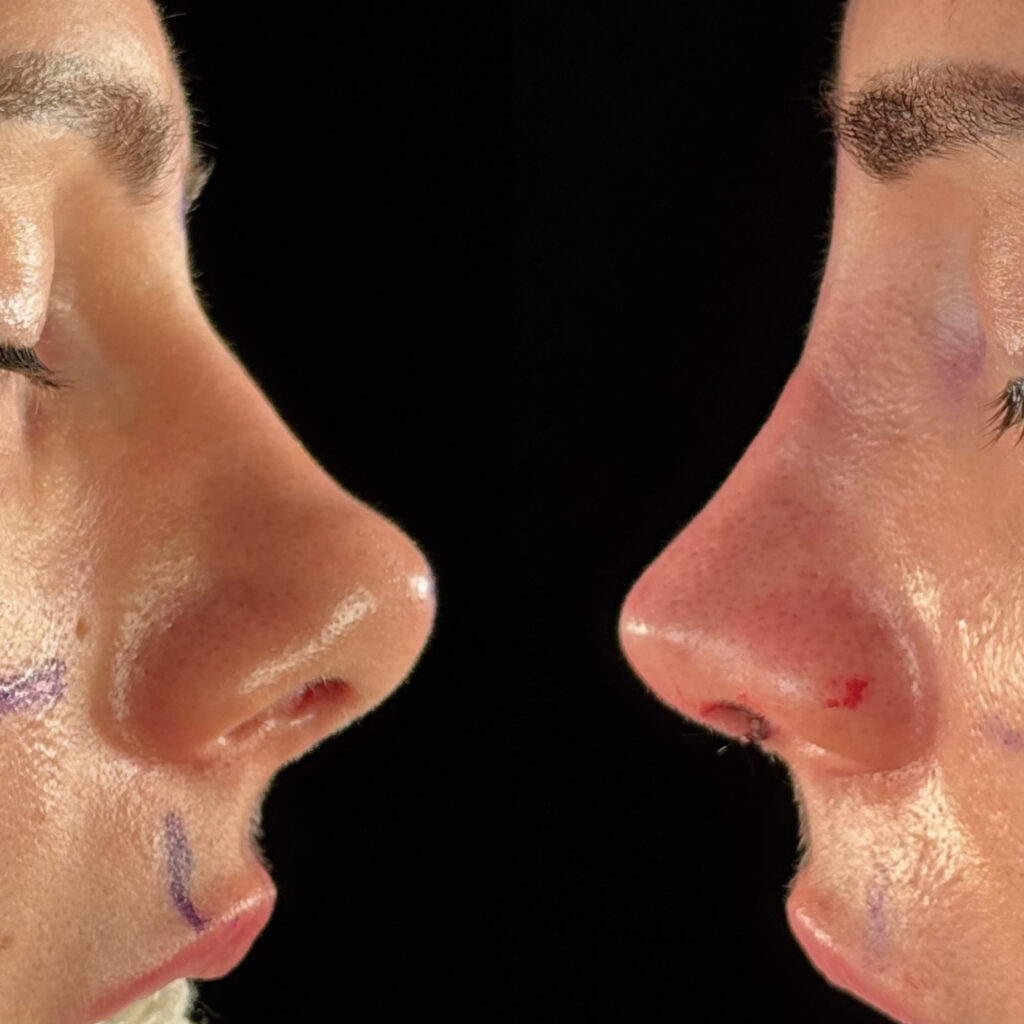 Antes e depois de paciente com rinoplastia natural em Salvador