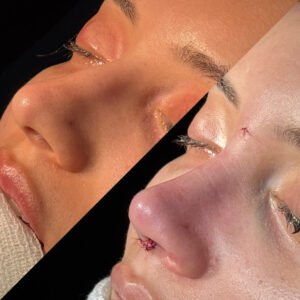 Antes e depois de rinoplastia natural em Salvador realizada por Dr. Gabriel Bijos vista 45