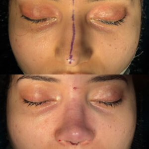 Antes e depois de rinoplastia natural em Salvador realizada por Dr. Gabriel Bijos - vista frontal