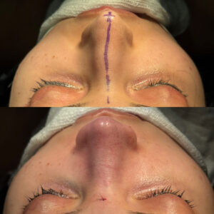 Antes e depois de rinoplastia natural em Salvador realizada por Dr. Gabriel Bijos Helicopter view