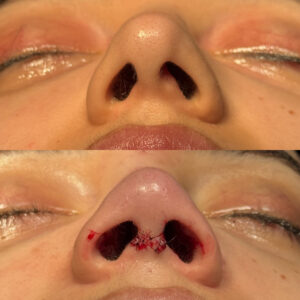 Antes e depois de rinoplastia natural em Salvador realizada por Dr. Gabriel Bijos base view