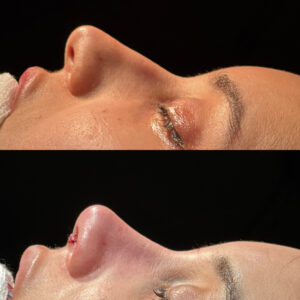 Antes e depois de rinoplastia natural em Salvador realizada por Dr. Gabriel Bijos - perfil esquerdo