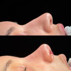 Antes e depois de rinoplastia natural em Salvador realizada por Dr. Gabriel Bijos - perfil direito