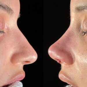 Antes e depois de rinoplastia natural em Salvador realizada por Dr. Gabriel Bijos - comparativo