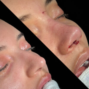 Antes e depois de rinoplastia natural em Salvador realizada por Dr. Gabriel Bijos - vista 45 graus direita
